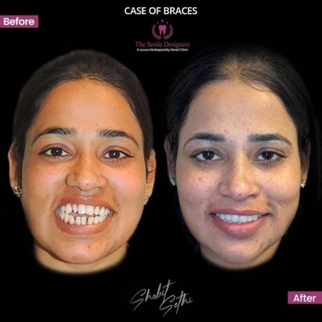 Best Dentist near me -Braces Cases