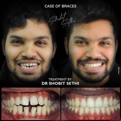 Best Dentist in Mohali -Braces Cases