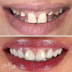 Dental implant