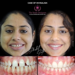 Braces Expert in mohali