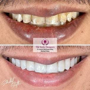 Teeth Whitening
