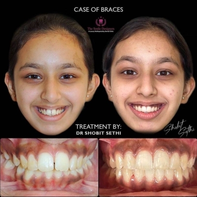 Veneers Case - best dentist in mohali