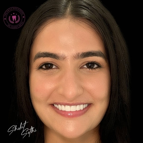 Best Dentist in Mohali - veneers cases