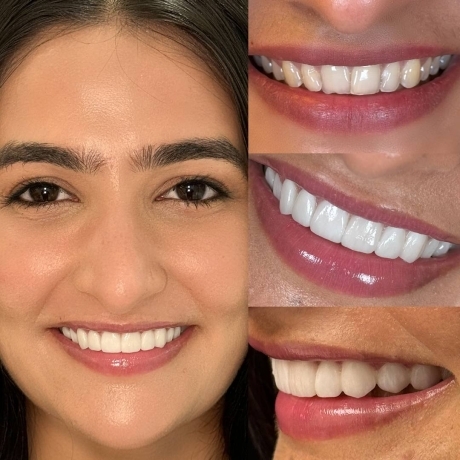 Best dental clinic in mohali - veneers cases