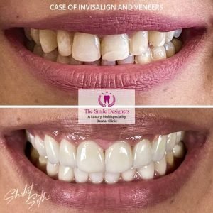 The Smile Designers -veneers