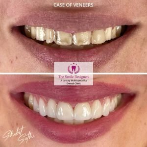 The Smile Designers -veneers
