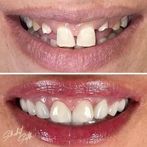 The Smile Designers- veneer close