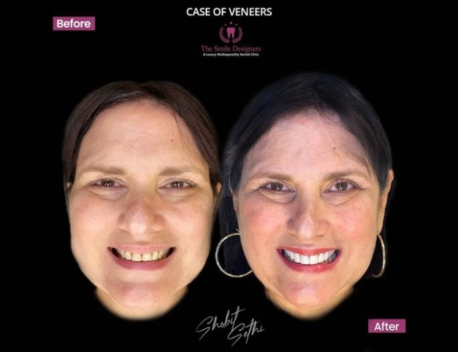 Dental Veneers and Laminates in Chandigarh