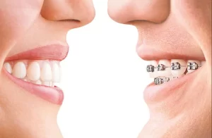 Invisalign vs. Traditional Braces: Which is Best for You?