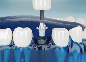 How Dental Implants Transform Smiles and Quality of Life