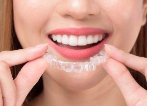 Invisalign Magic: Comfortable, Invisible, and Life-Changing Smiles
