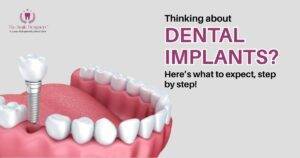 Step-by-Step Procedure: What to Expect During Dental Implants