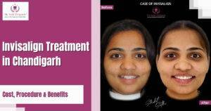 Invisalign Treatment in Chandigarh: Cost, Procedure, and Benefits