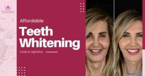 Affordable Teeth Whitening in Chandigarh – Cost and Options
