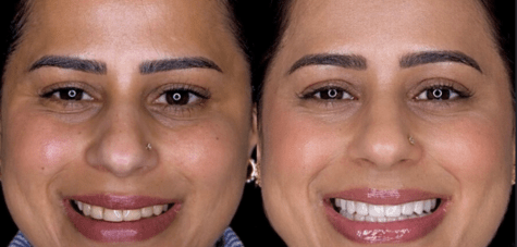 Smile Makeover in Chandigarh