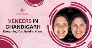 Veneers in Chandigarh: Everything You Need to Know