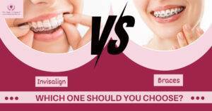 Invisalign vs Braces in Chandigarh – Which One Should You Choose?