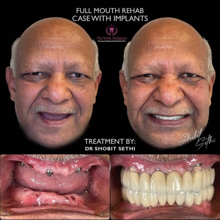 best dentist in mohali - dental implant