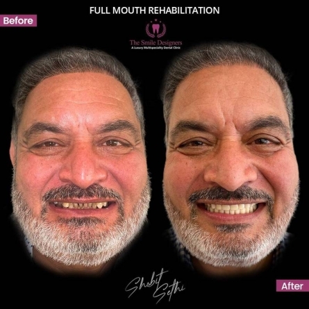 dental implants - Best Dentist in Mohali