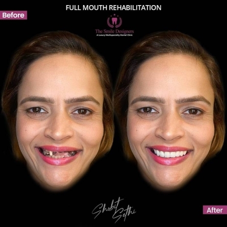 dental implant in chandigarh