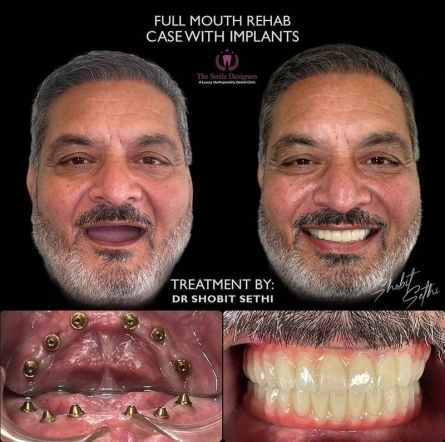 dental clinic near me - dental implant case