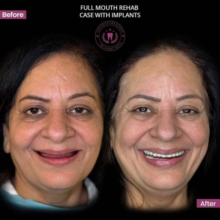 Best dentist in mohali - dental implant case