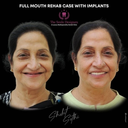 best dental clinic in mohali - dental implant
