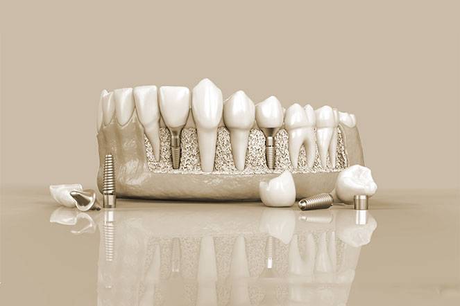 dental implant doctor in chandigarh