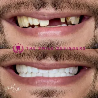 Best Dentist in Chandigarh Mohali Before-After-Crown-Venners-Patient-Photos - The Smile Designers