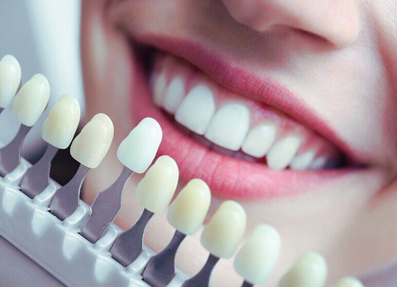 Understanding Dental Laminates: What Are They and How Do They Work?
