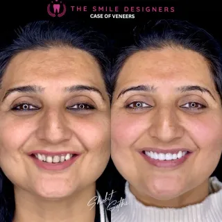 Veneers Before After Photos - The Smile Designers - Best Dentist In Chandigarh